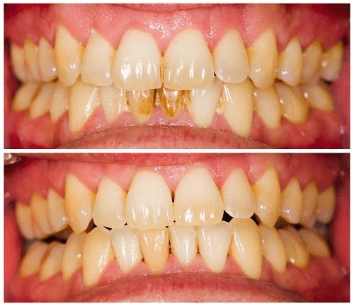 Teeth Cleaning & Scaling